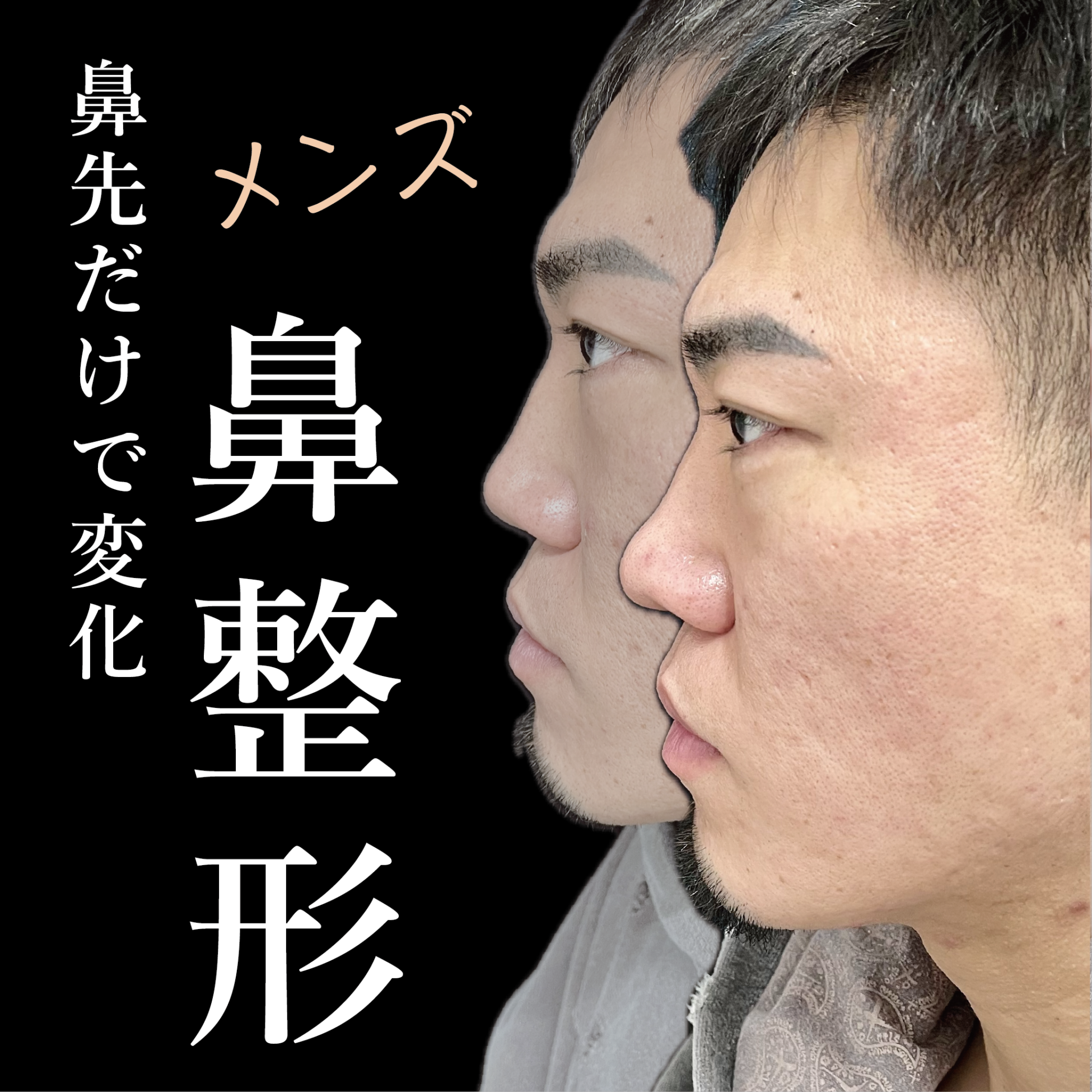 大宮の20代男性の鼻整形の症例