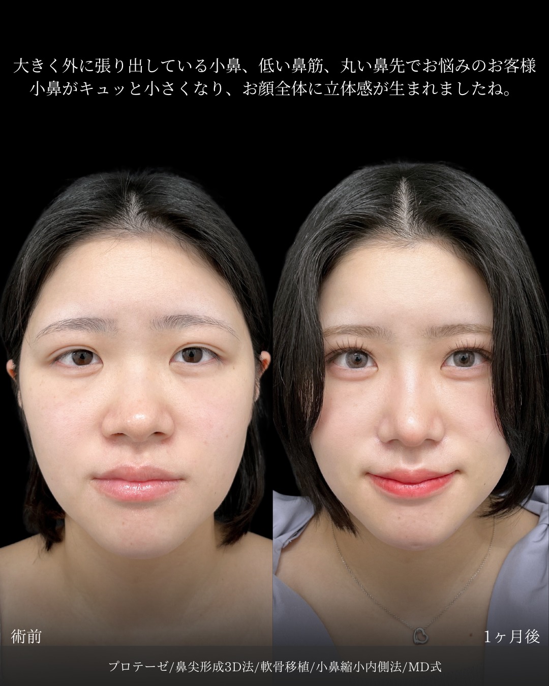 プロテーゼと鼻尖形成3D法と軟骨移植と小鼻縮小内側法をMD式でうけた女性の症例写真