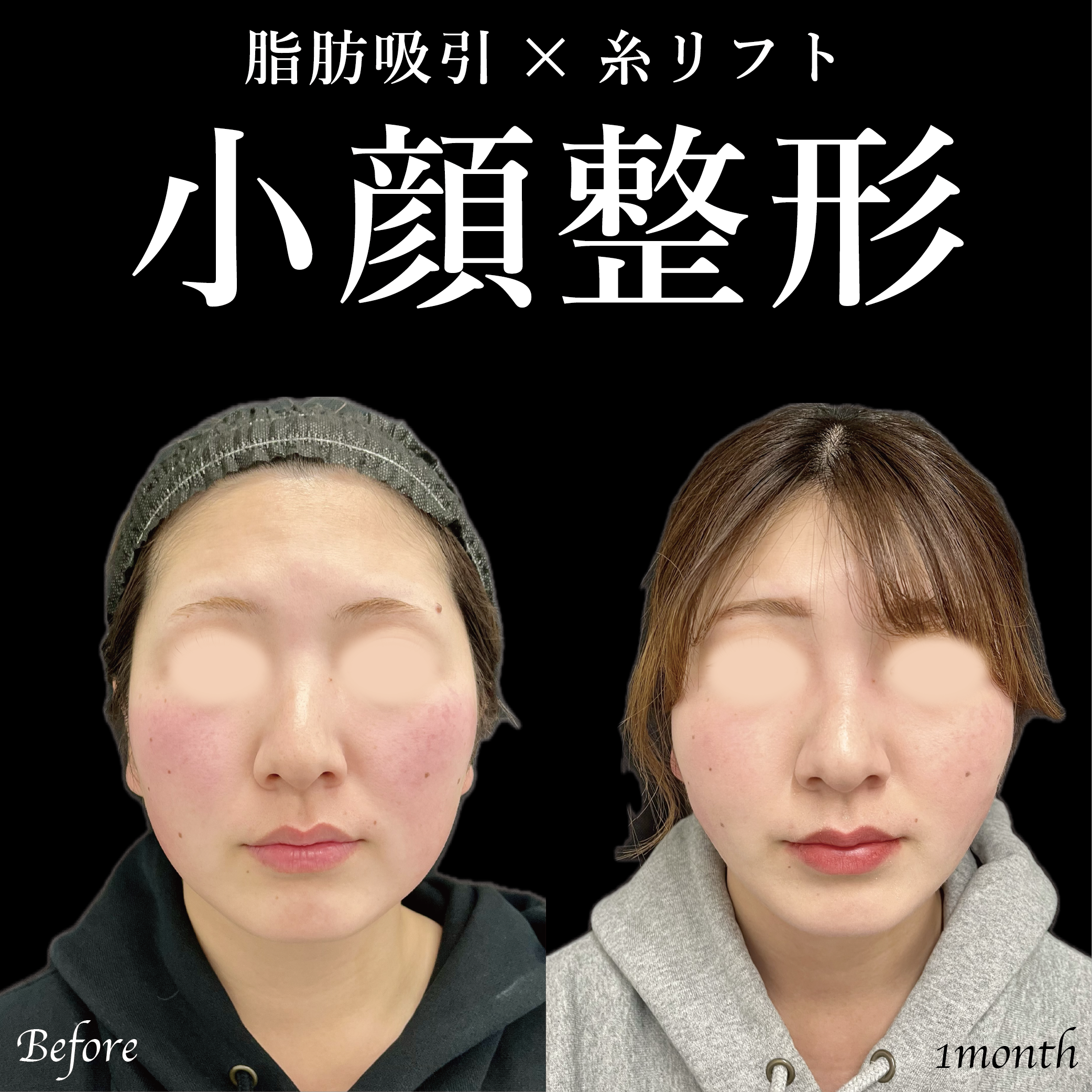 大宮の20代女性の小顔整形の症例