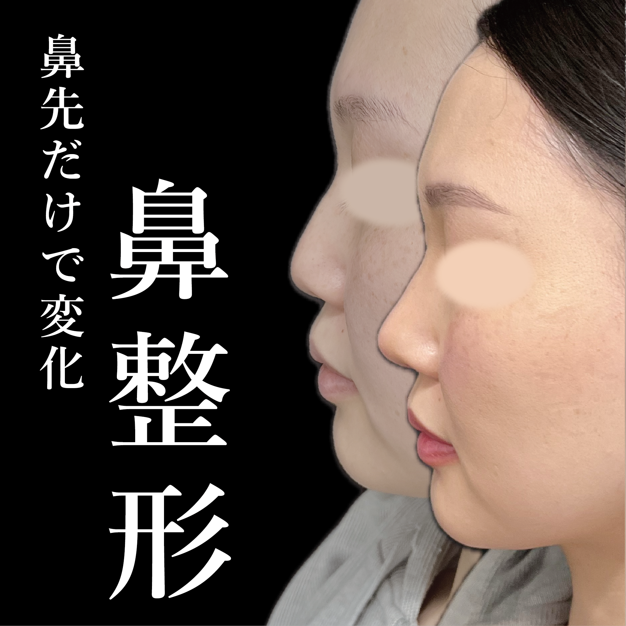 大宮の20代女性の鼻整形の症例
