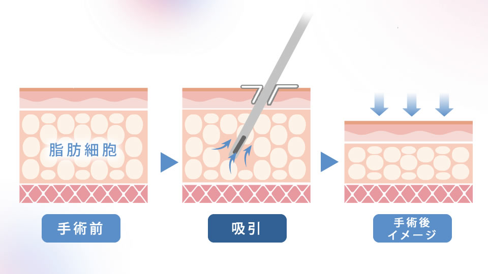 東京シンデレラ美容外科の脂肪吸引の図解