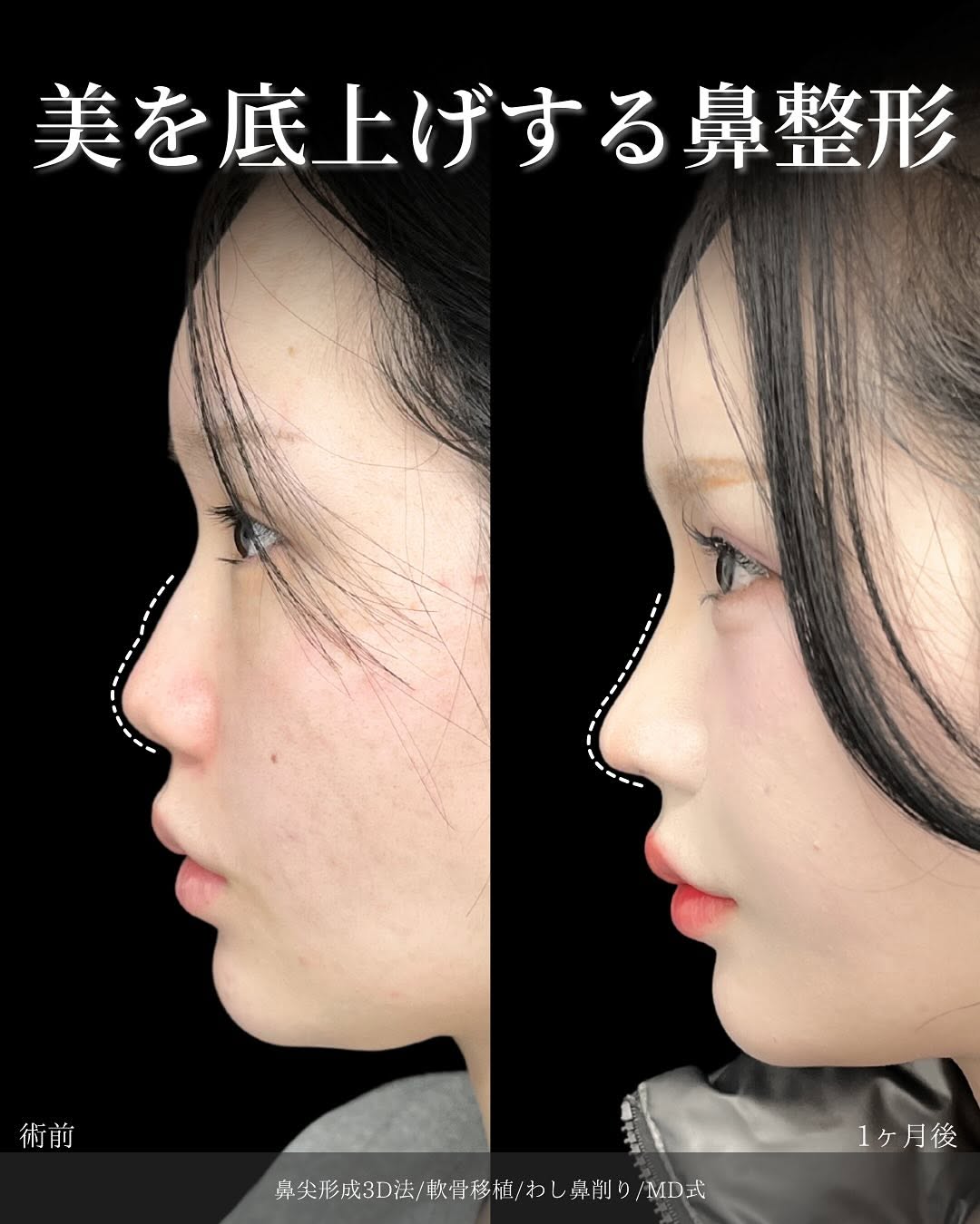 鼻尖形成3D法と軟骨移植とわし鼻削りをMD式でうけた女性の症例写真