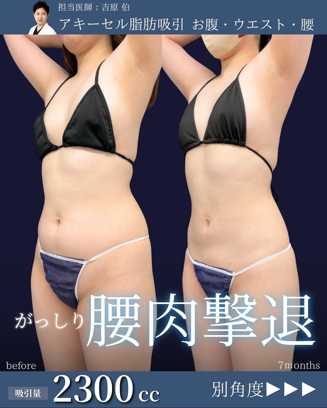 お腹とウエストと腰のアキーセル脂肪吸引を受けた女性の症例写真