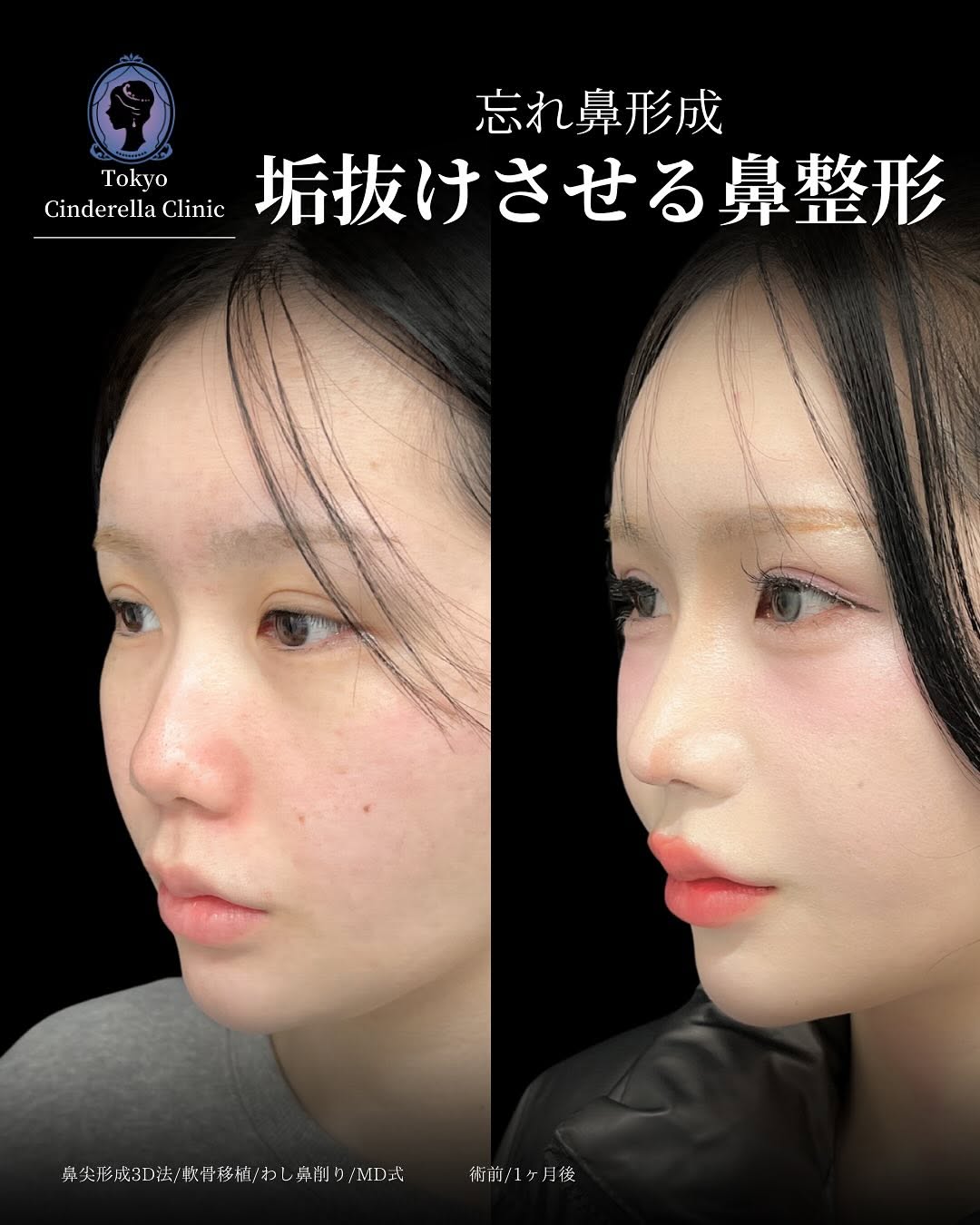 鼻尖形成3D法と軟骨移植とわし鼻削りをMD式でうけた女性の症例写真