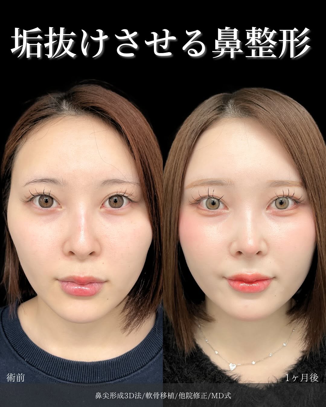 鼻尖形成3D法と軟骨移植をMD式でうけた女性の症例写真
