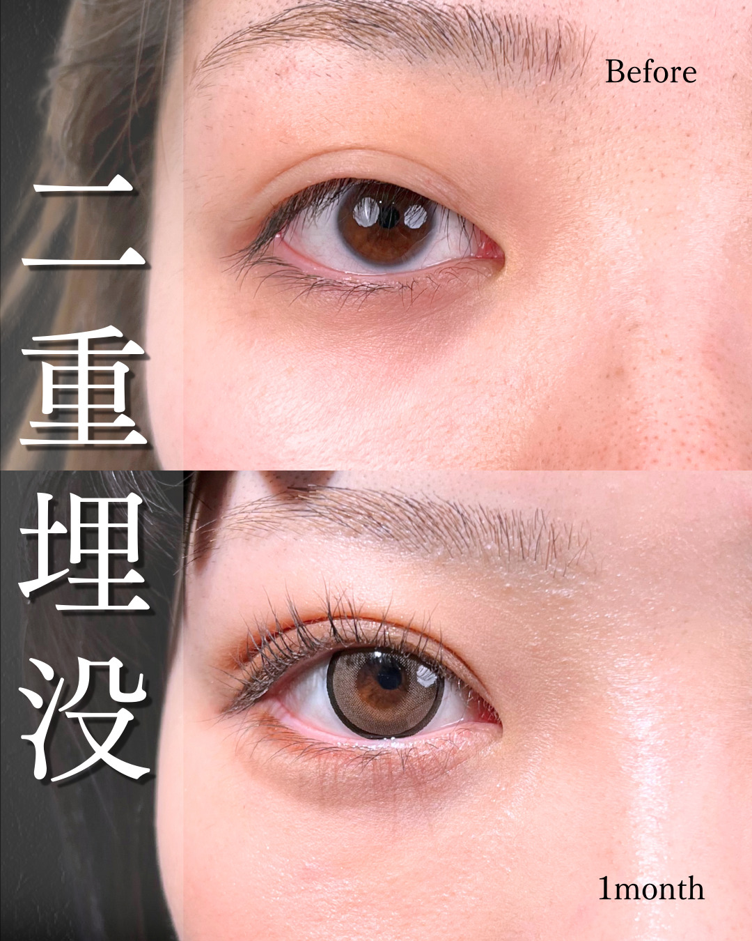 20代の埋没法の1ヶ月後の症例写真