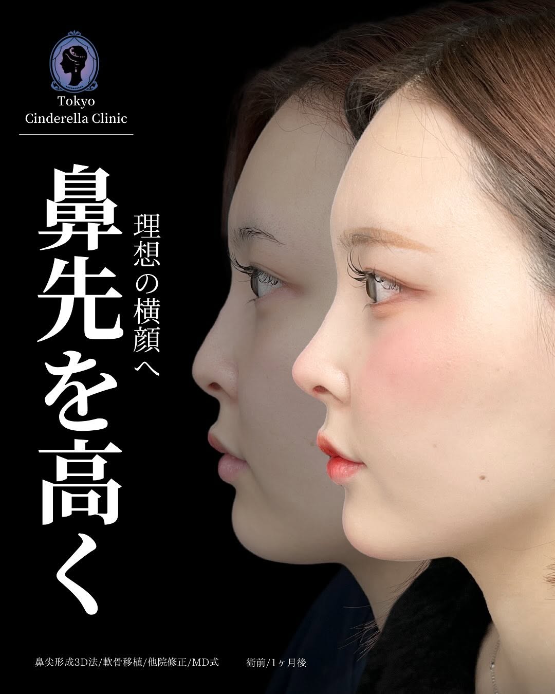 鼻尖形成3D法と軟骨移植をMD式でうけた女性の症例写真