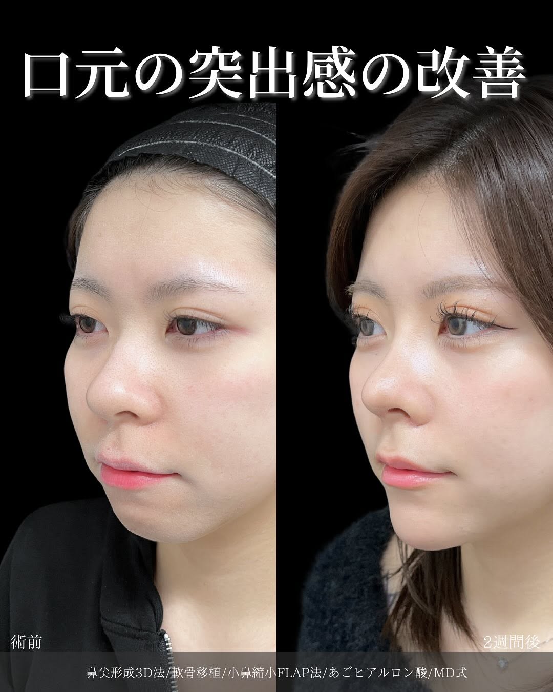 鼻尖形成3D法と軟骨移植と小鼻縮小FLAP法とあごヒアルロン酸をMD式でうけた女性の症例写真