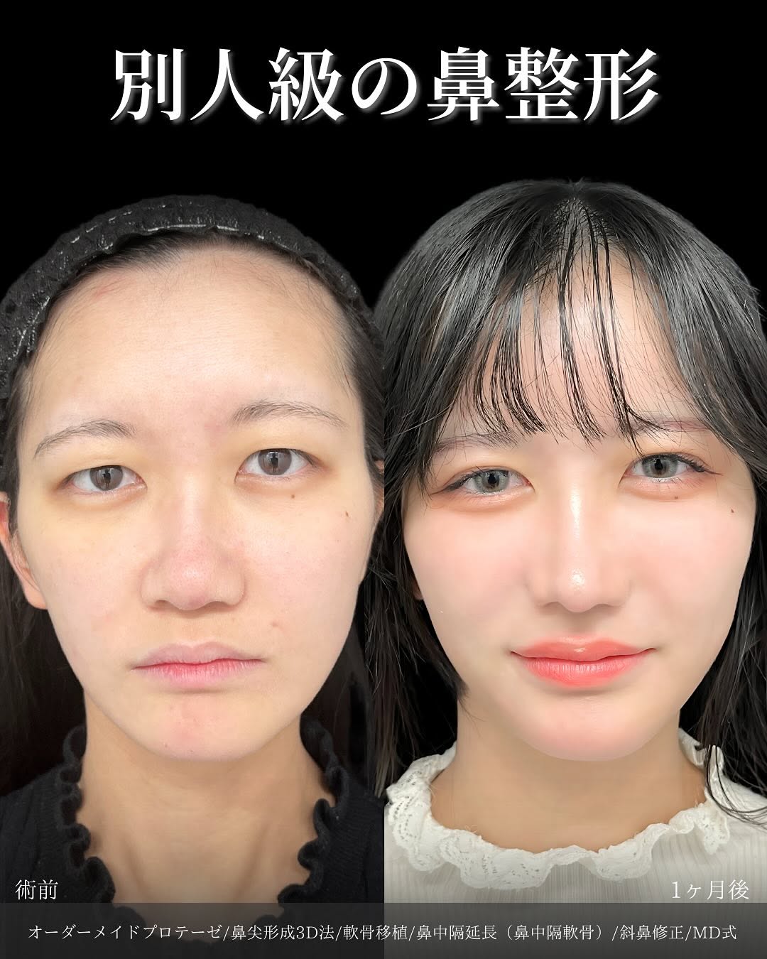 新宿院で行った鼻整形の名医の吉原伯医師のMD式のオーダーメイドプロテーゼと鼻尖形成3D法と軟骨移植と鼻中隔延長(鼻中隔軟骨)と斜鼻修正の症例写真