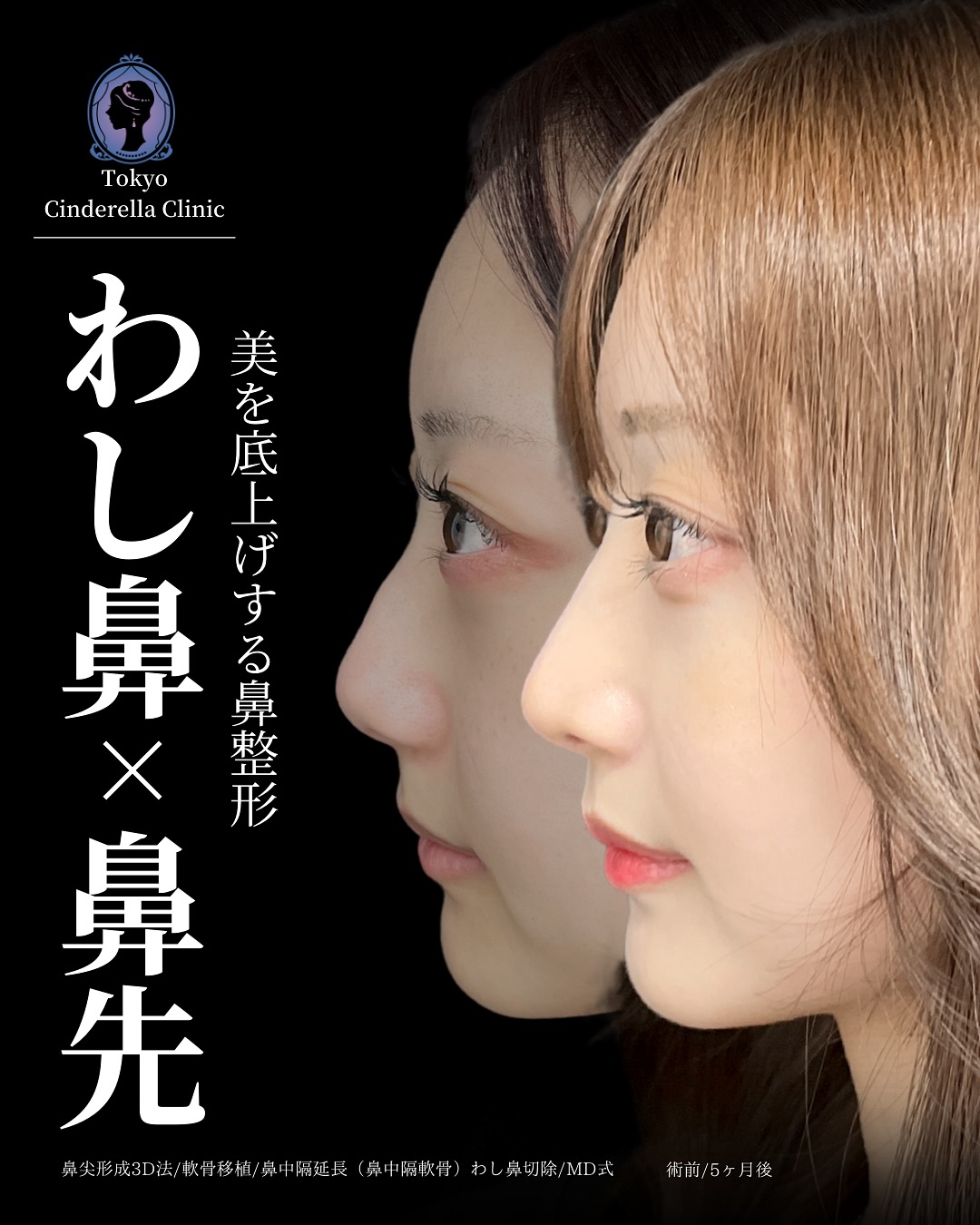 新宿院で行った鼻整形の名医の吉原伯医師のMD式の鼻尖形成3D法と軟骨移植と鼻中隔延長(鼻中隔軟骨)とわし鼻切除の症例写真