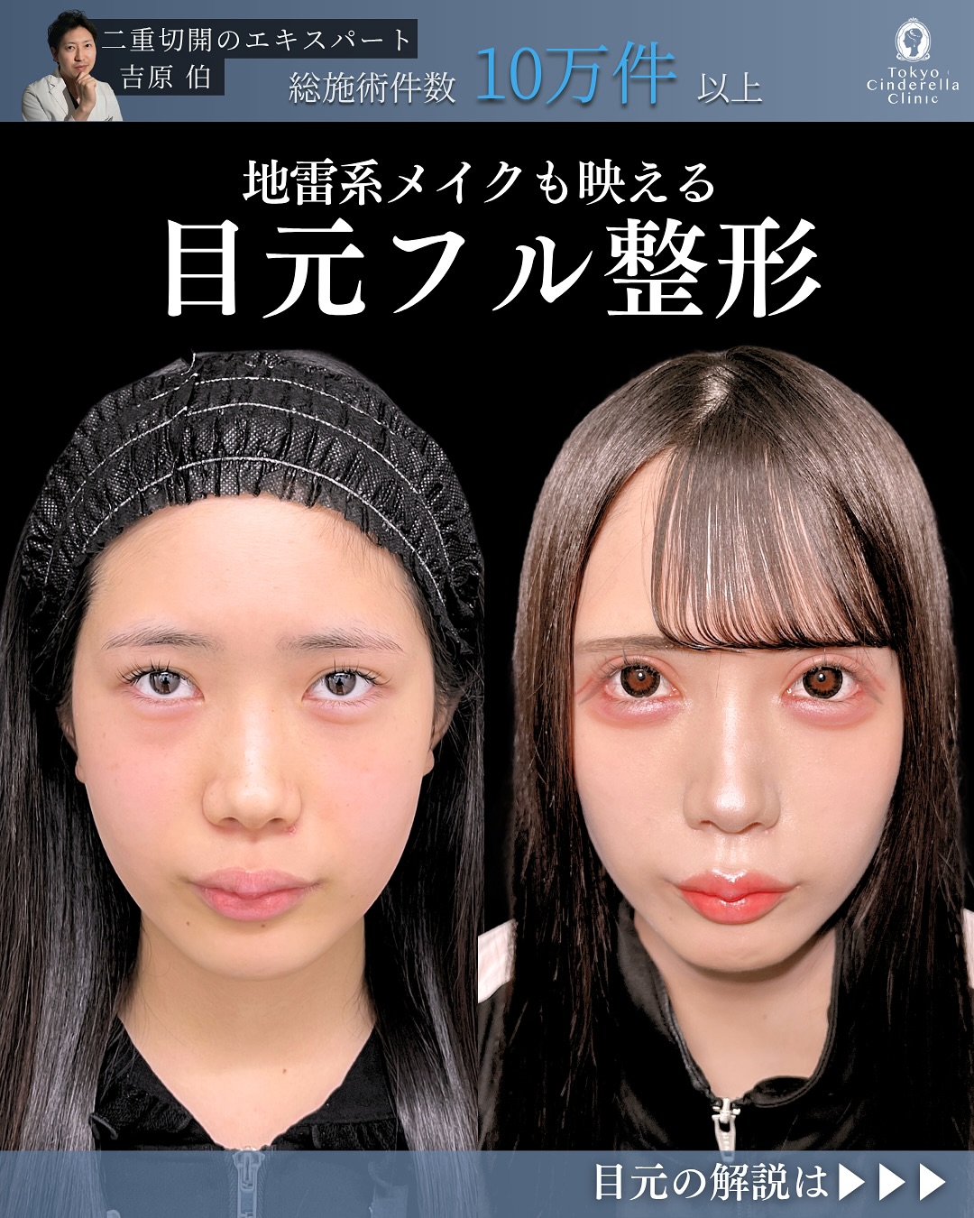新宿院で行った二重整形で有名な吉原伯医師のMD式のたるみ取り併用全切開法二重術と眼瞼下垂手術と目頭切開とタレ目形成(結膜切開)と切らないクマ取りと埋没法抜糸の1ヶ月後の症例写真