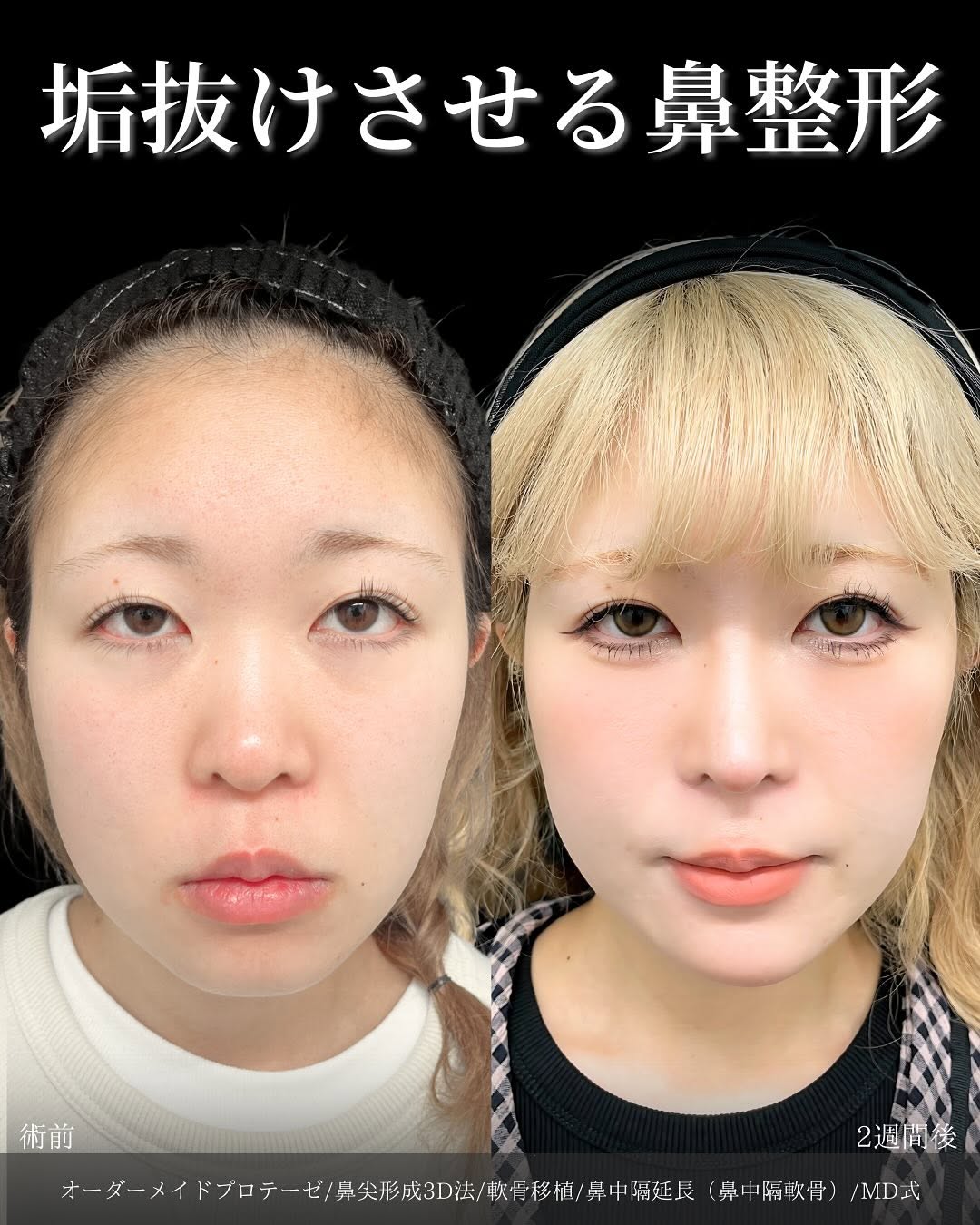 新宿院で行った鼻整形の名医の吉原伯医師のMD式のオーダーメイドプロテーゼと鼻尖形成3D法と軟骨移植と鼻中隔延長(鼻中隔軟骨)の症例写真