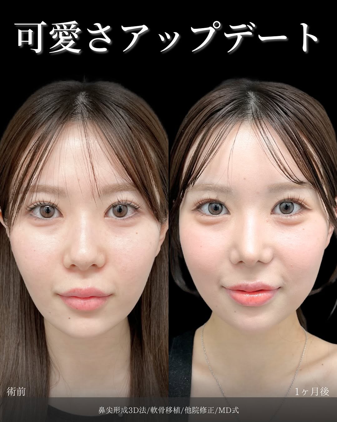 新宿院で行った鼻整形の名医の吉原伯医師のMD式の鼻尖形成3D法と軟骨移植と他院修正の症例写真
