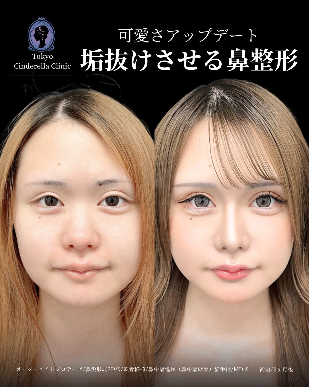新宿院で行った鼻整形の名医の吉原伯医師のMD式のオーダーメイドプロテーゼと鼻尖形成3D法と軟骨移植と鼻中隔延長(鼻中隔軟骨)と猫手術の症例写真