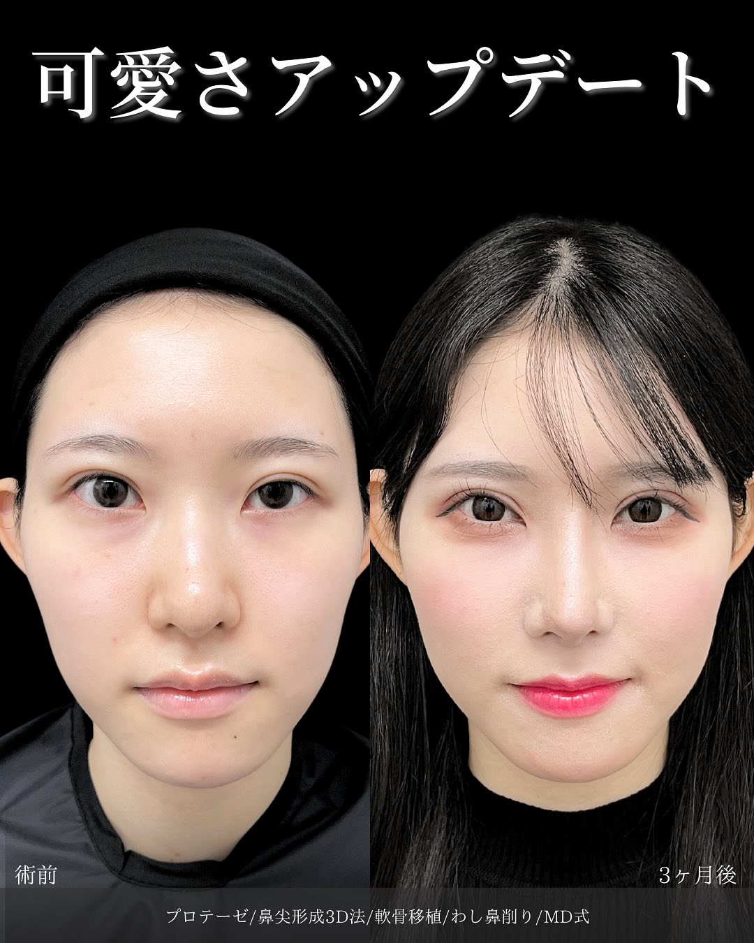 新宿院で行った鼻整形の名医の吉原伯医師のMD式のプロテーゼと鼻尖形成3D法と軟骨移植とわし鼻削りの症例写真