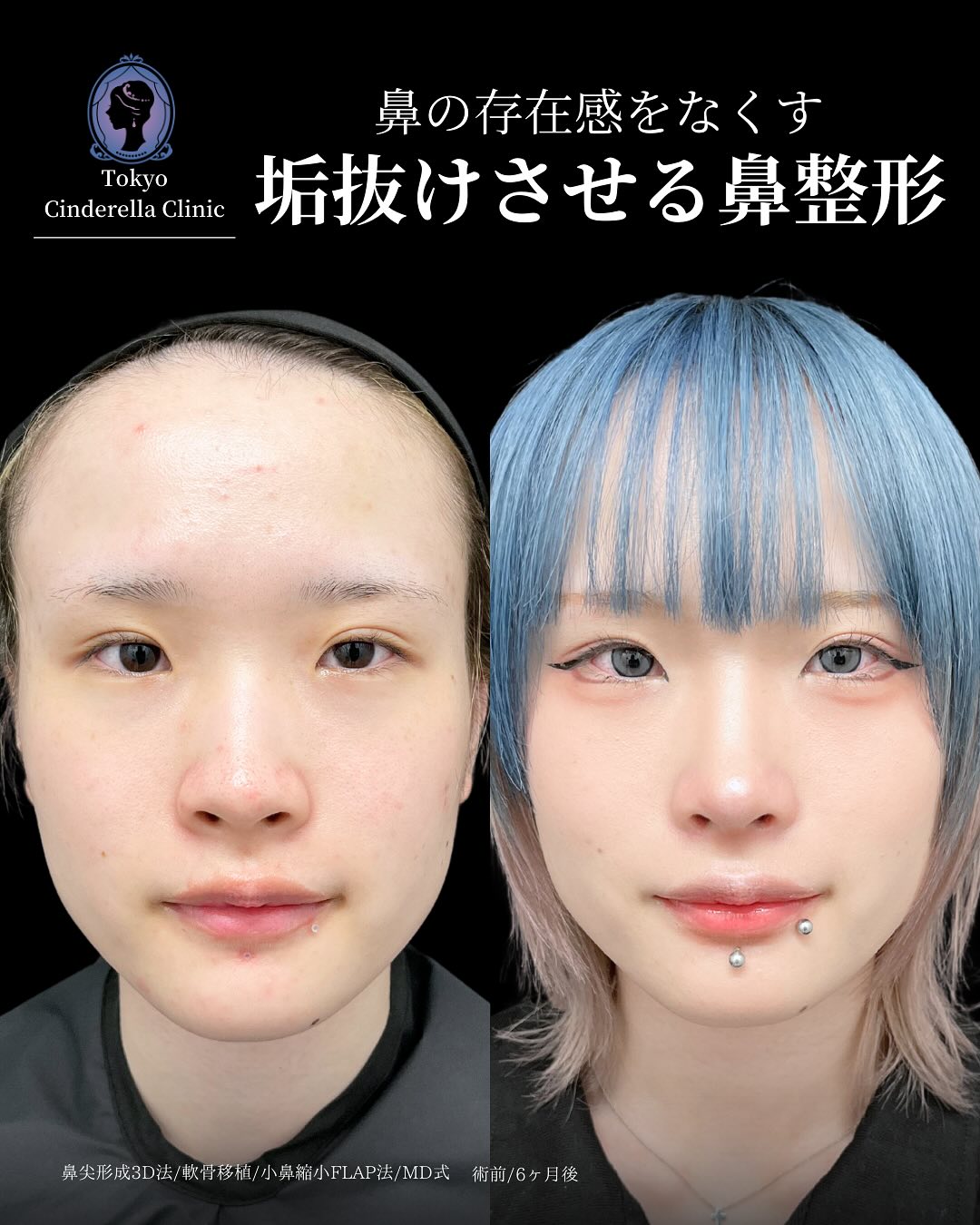 新宿院で行った鼻整形の名医の吉原伯医師のMD式の鼻尖形成3D法と軟骨移植と小鼻縮小FLAP法の症例写真