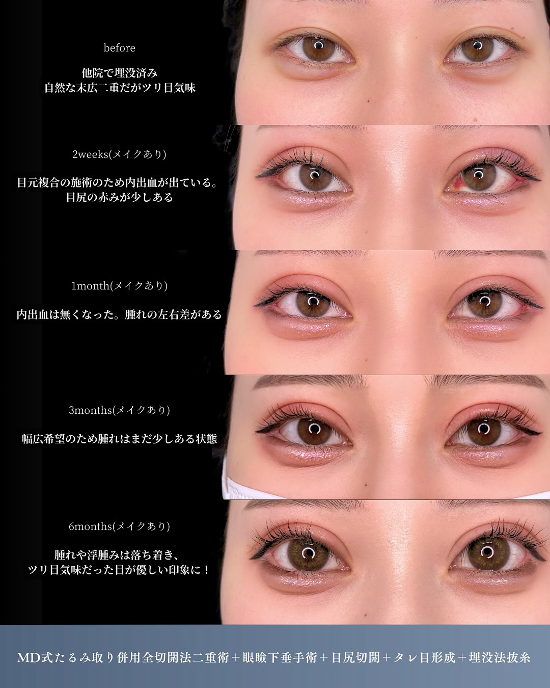 新宿院で行った二重整形で有名な吉原伯医師のMD式のたるみ取り併用全切開法二重術と眼瞼下垂手術と目尻切開とタレ目形成(結膜切開)と埋没法抜糸の6ヶ月後の症例写真