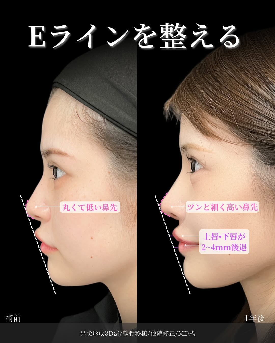 新宿院で行った鼻整形の名医の吉原伯医師のMD式の鼻尖形成3D法と軟骨移植と他院修正の症例写真