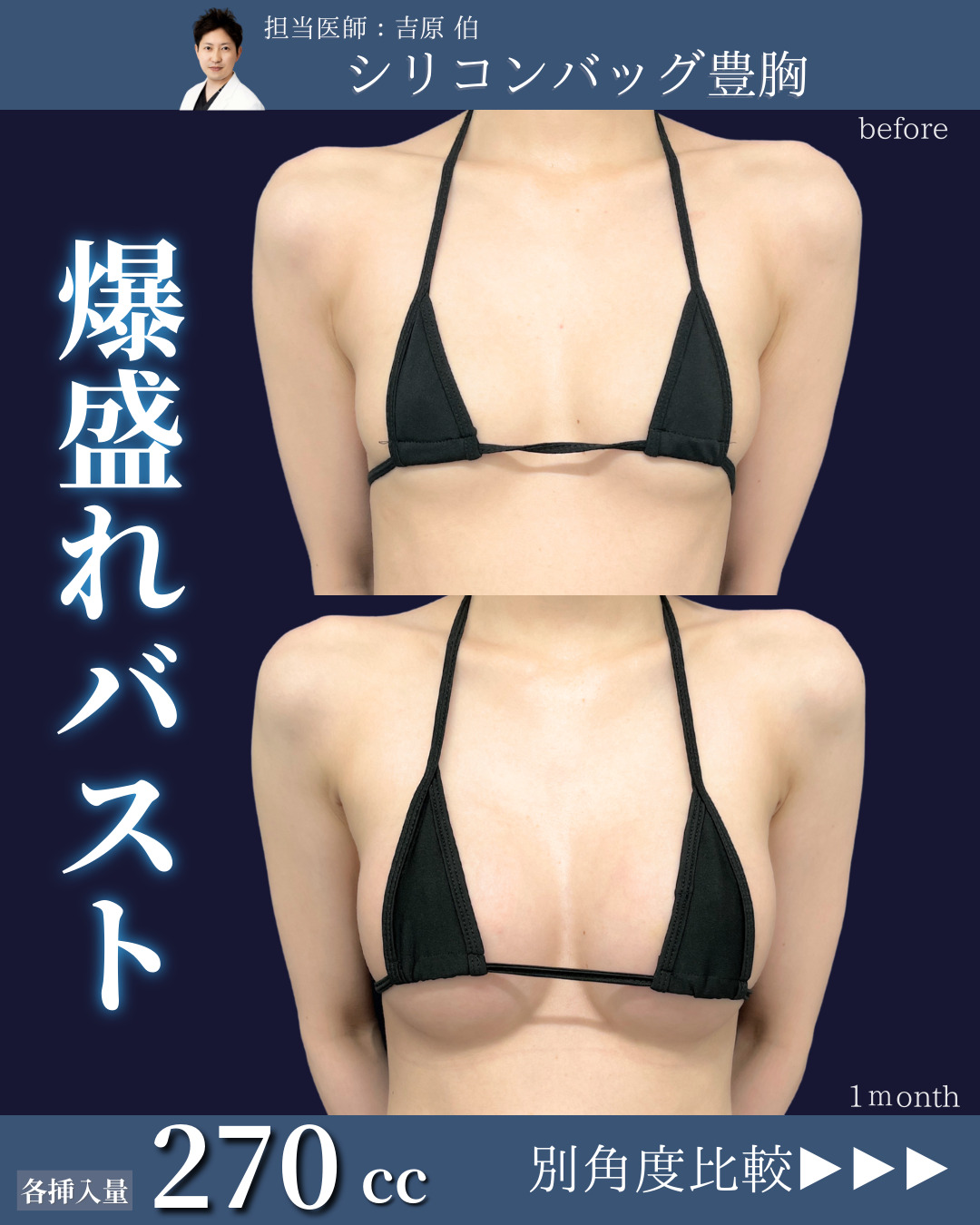 新宿院で行ったシリコンバッグ豊胸の名医の吉原伯医師の症例写真