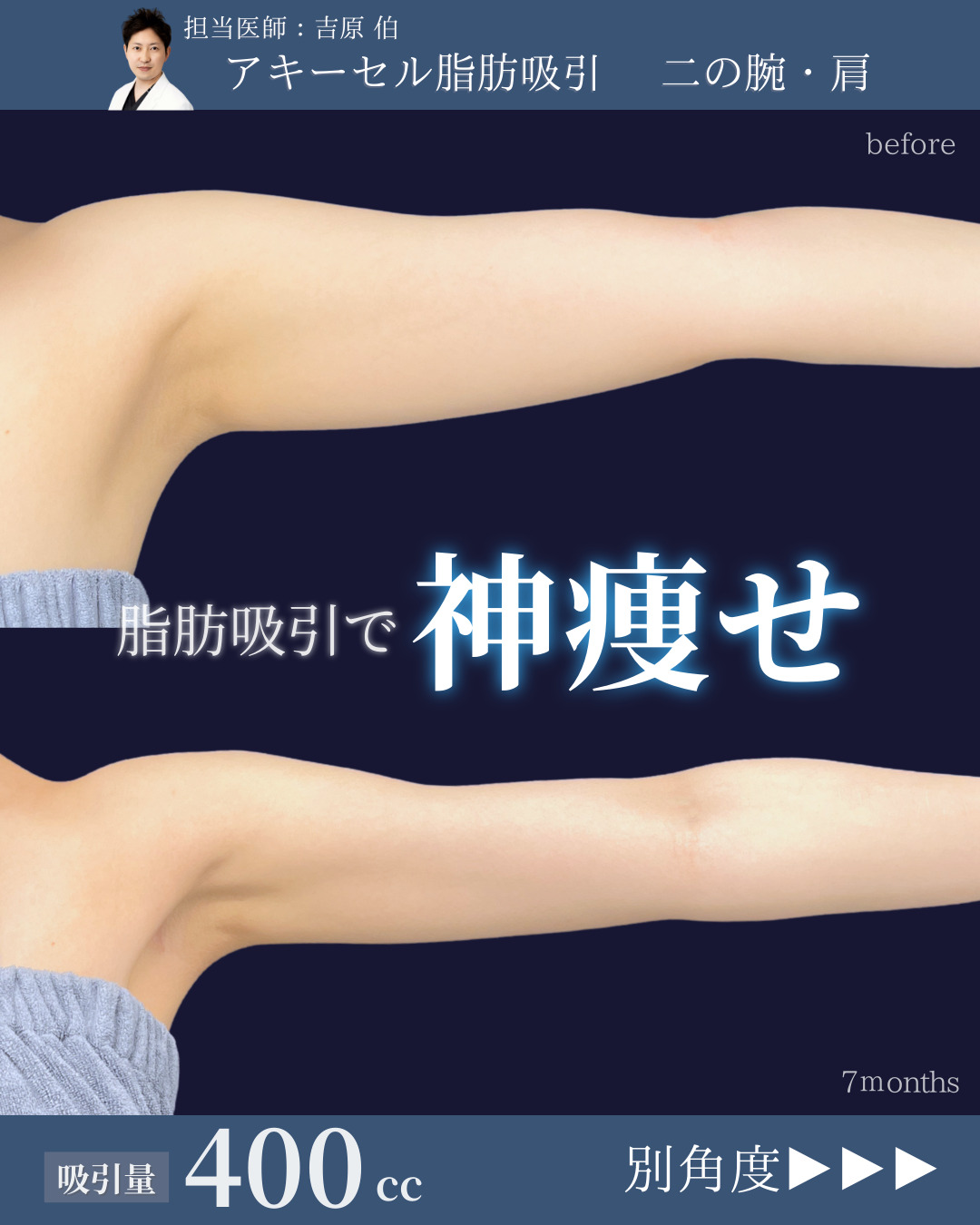 新宿院で行ったアキーセル脂肪吸引(二の腕・肩)の名医の吉原伯医師の症例写真