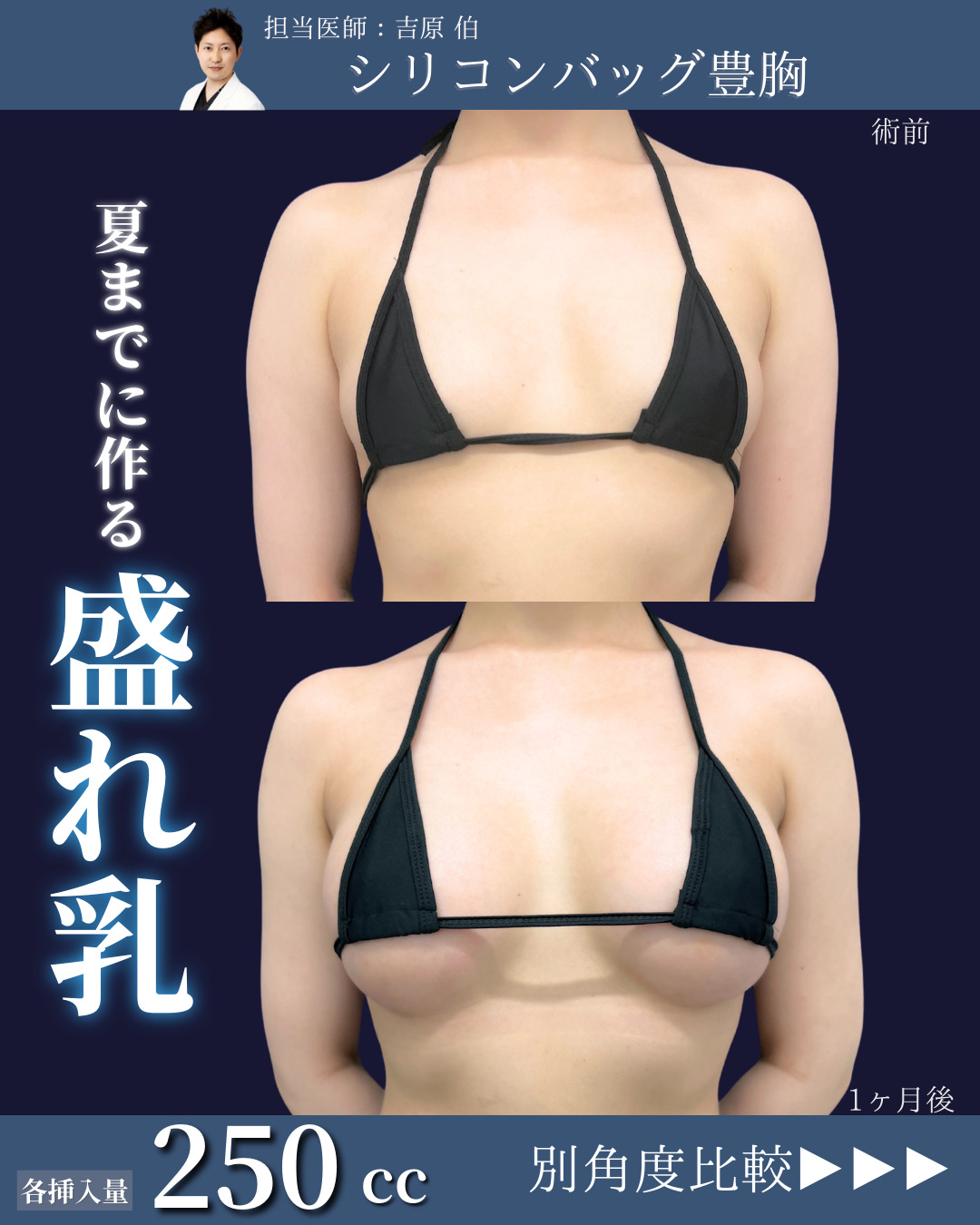 新宿院で行ったシリコンバッグ豊胸の名医の吉原伯医師の症例写真