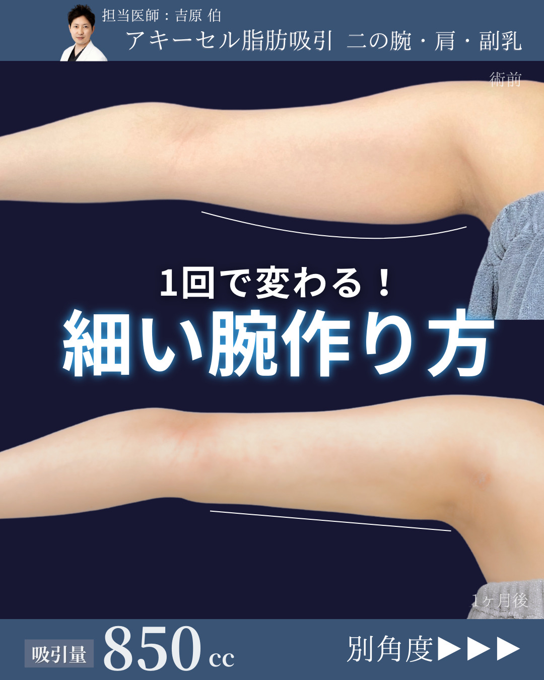 新宿院で行ったアキーセル脂肪吸引(二の腕・肩・副乳)の名医の吉原伯医師の症例写真
