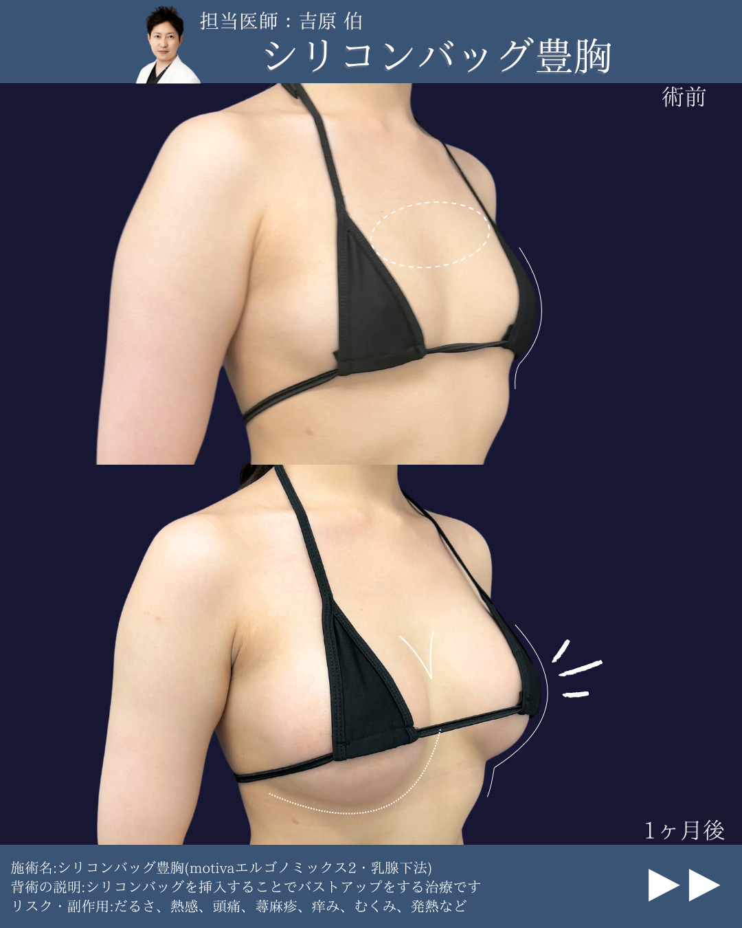 新宿院で行ったシリコンバッグ豊胸の名医の吉原伯医師の症例写真