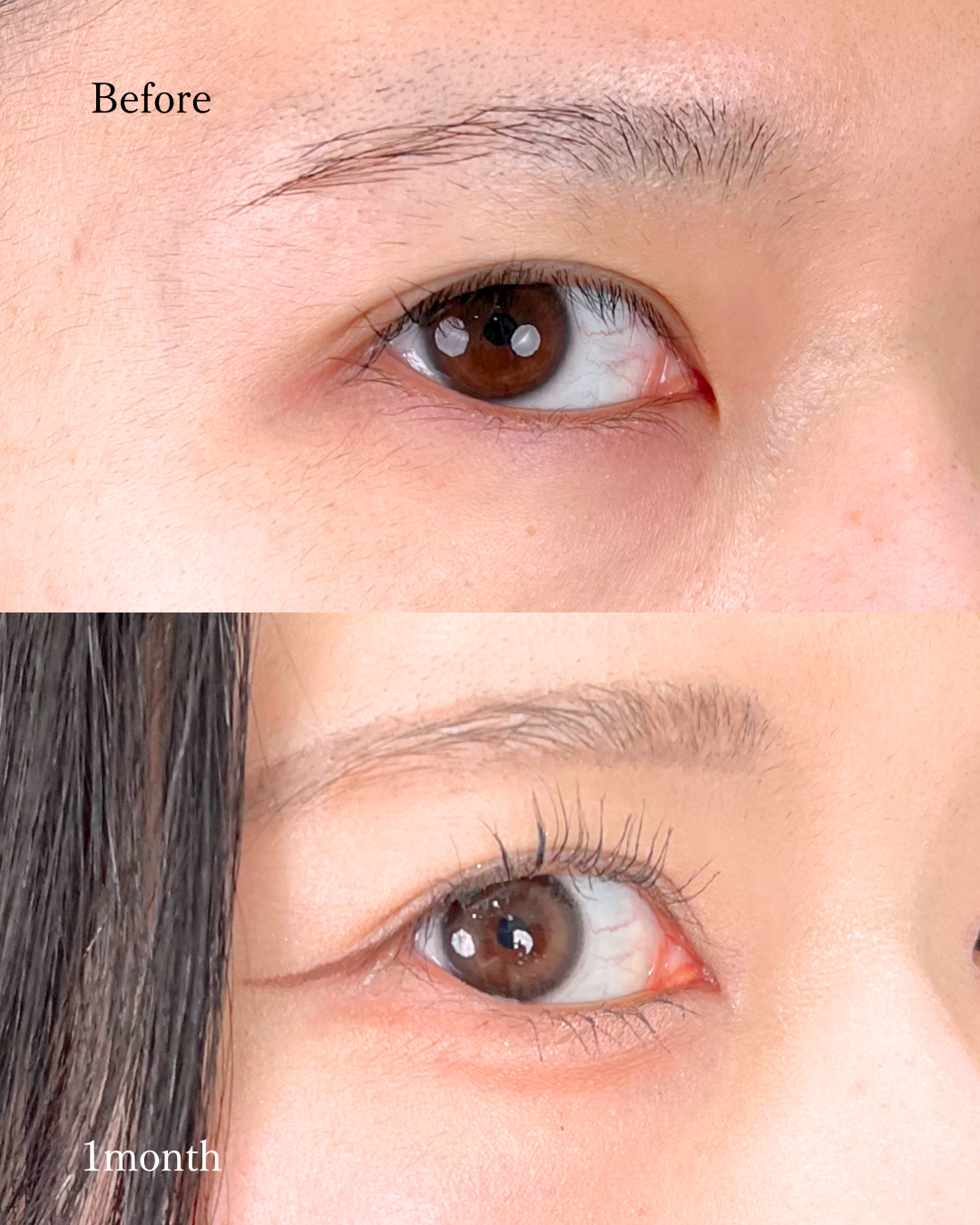 池袋院で行った目頭切開の名医の症例写真