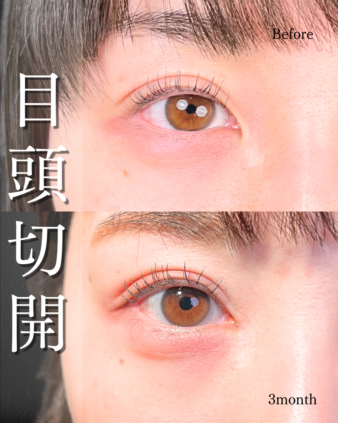 池袋院で行った目元整形の名医の症例写真