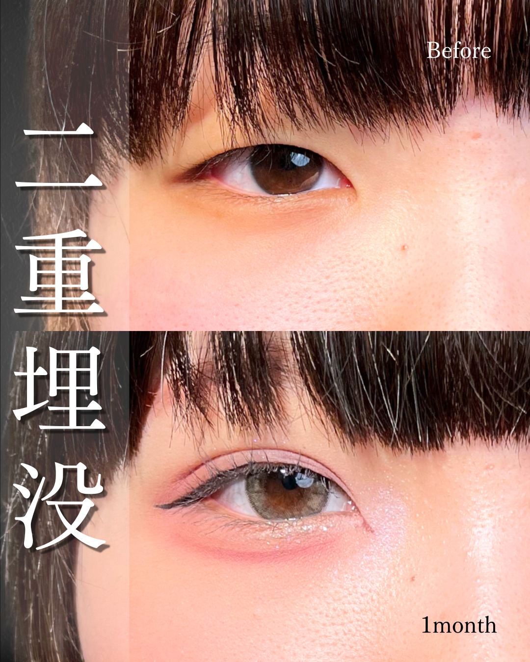 池袋院で行った二重整形で有名な名医の〇〇の症例写真