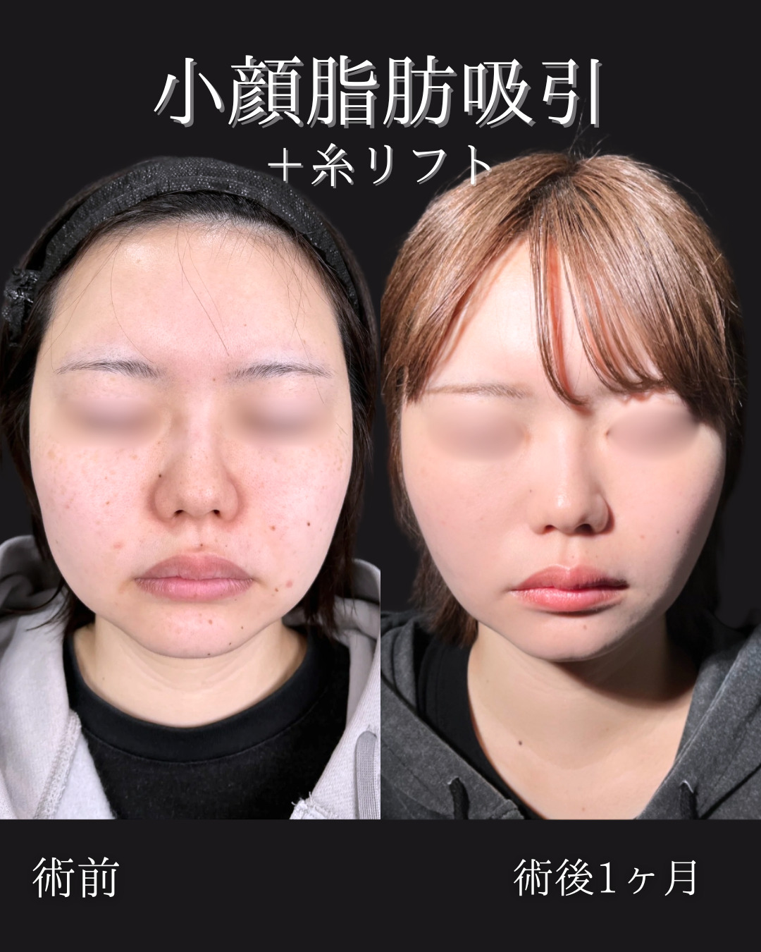 池袋院で行った小顔整形の石井達也医師の症例写真