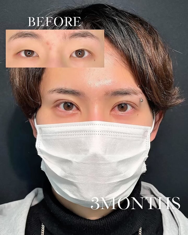 新宿院で行った二重整形で有名な吉原伯医師のMD式のたるみ取り併用全切開法二重術と眼瞼下垂手術と目頭切開の1ヶ月後の症例写真