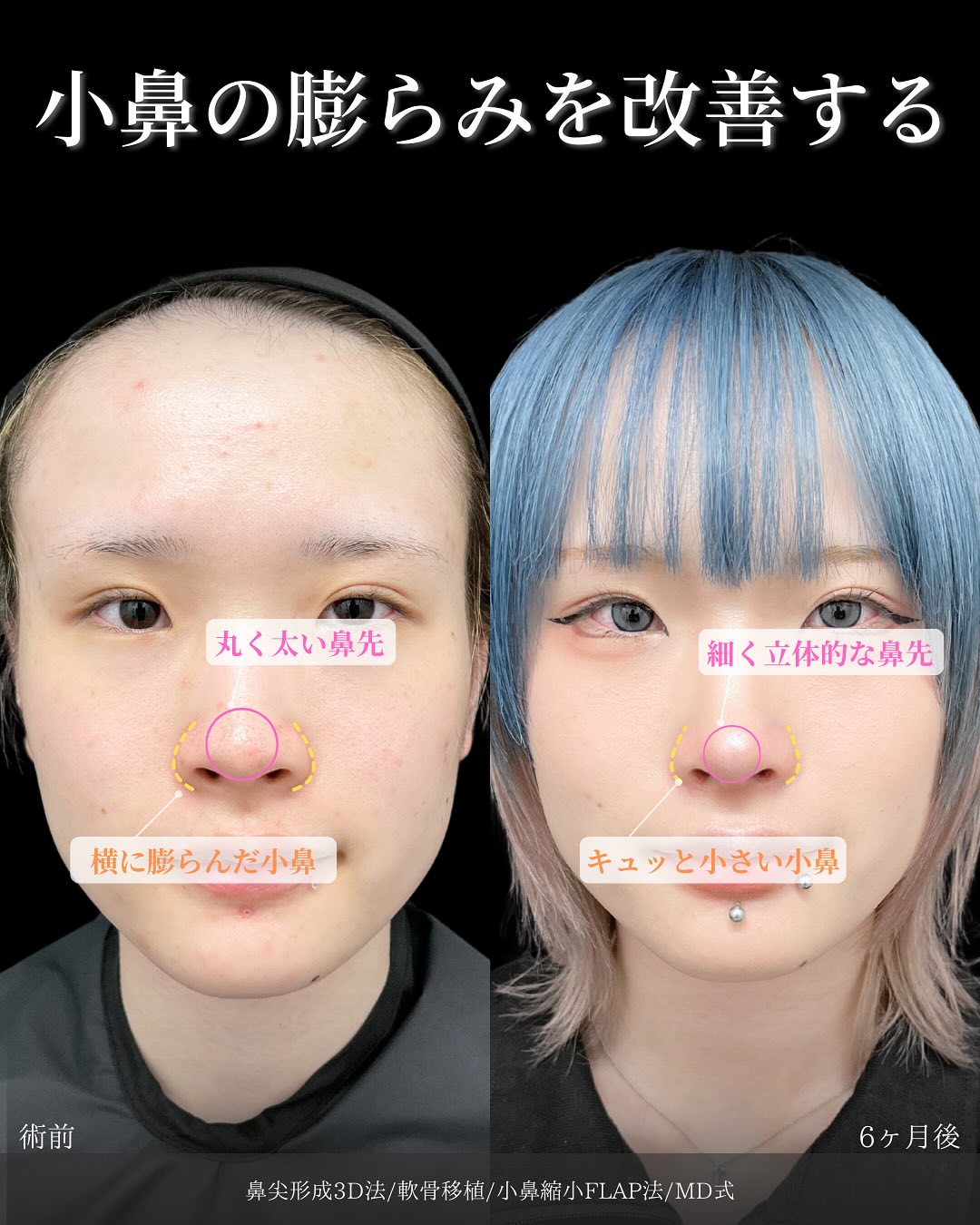 新宿院で行った鼻整形の名医の吉原伯医師のMD式の鼻尖形成3D法と軟骨移植と小鼻縮小FLAP法の症例写真