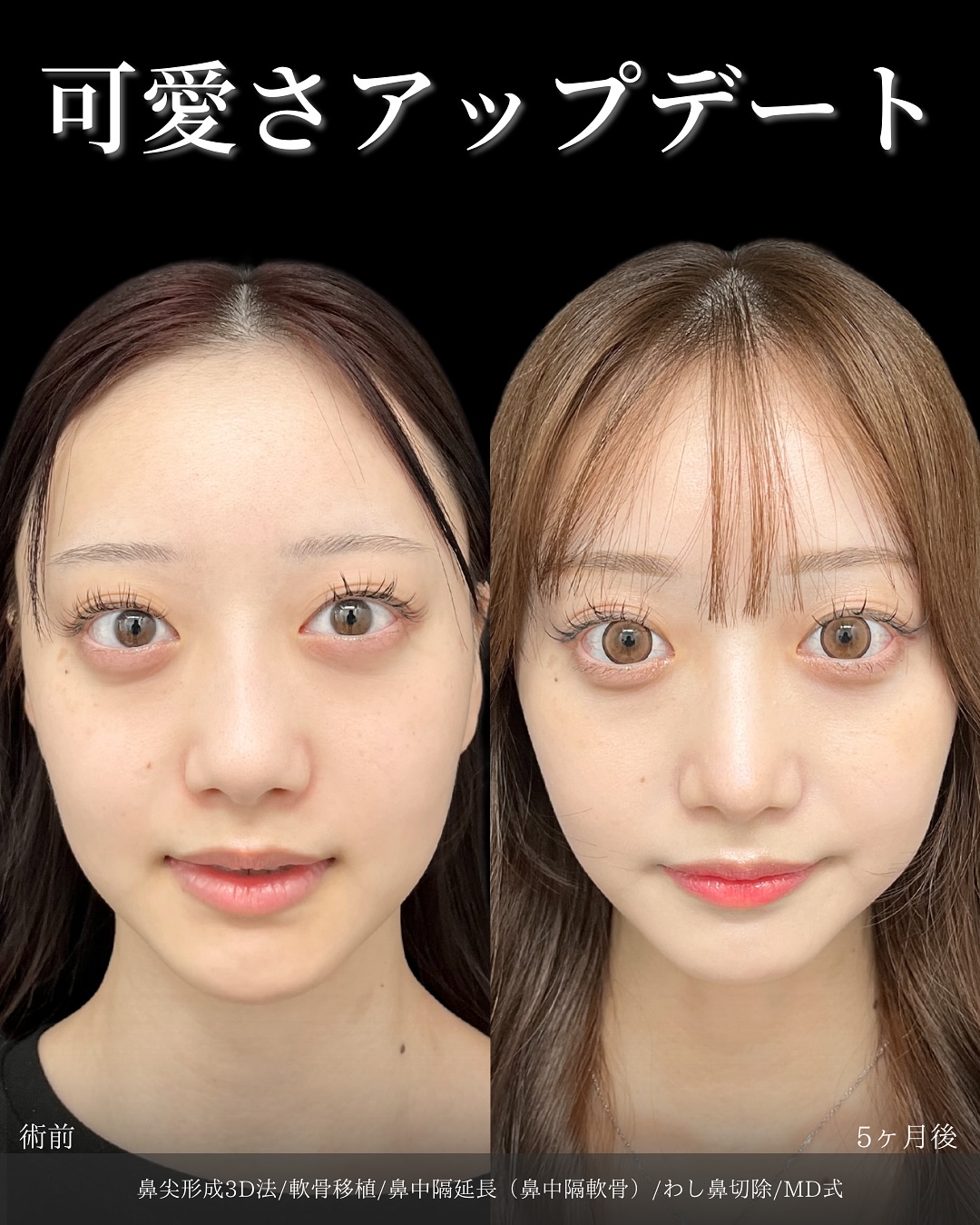 新宿院で行った鼻整形の名医の吉原伯医師のMD式の鼻尖形成3D法と軟骨移植と鼻中隔延長(鼻中隔軟骨)とわし鼻切除の症例写真