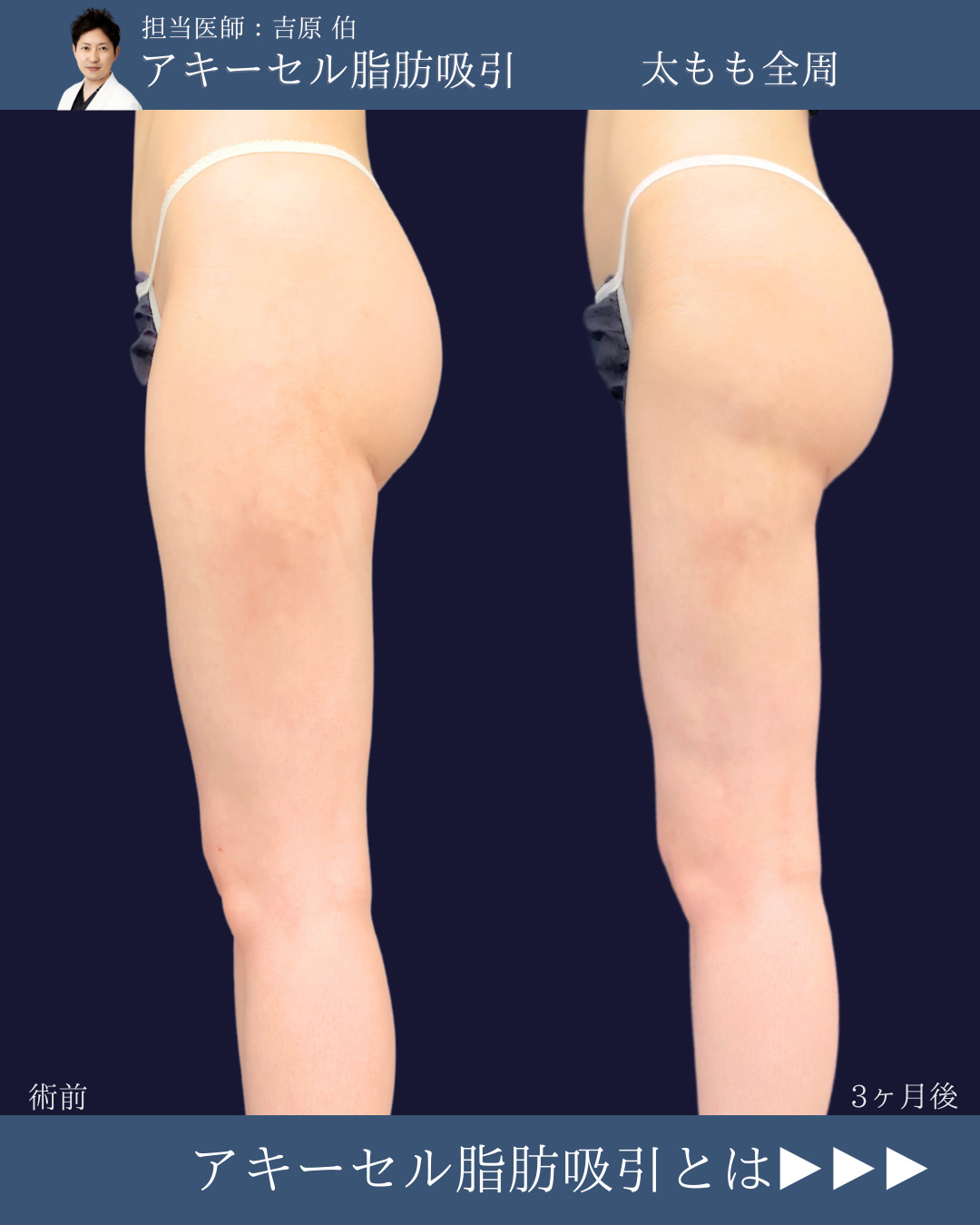 新宿院で行ったアキーセル脂肪吸引(太もも全周) と他院修正の名医の吉原伯医師の症例写真