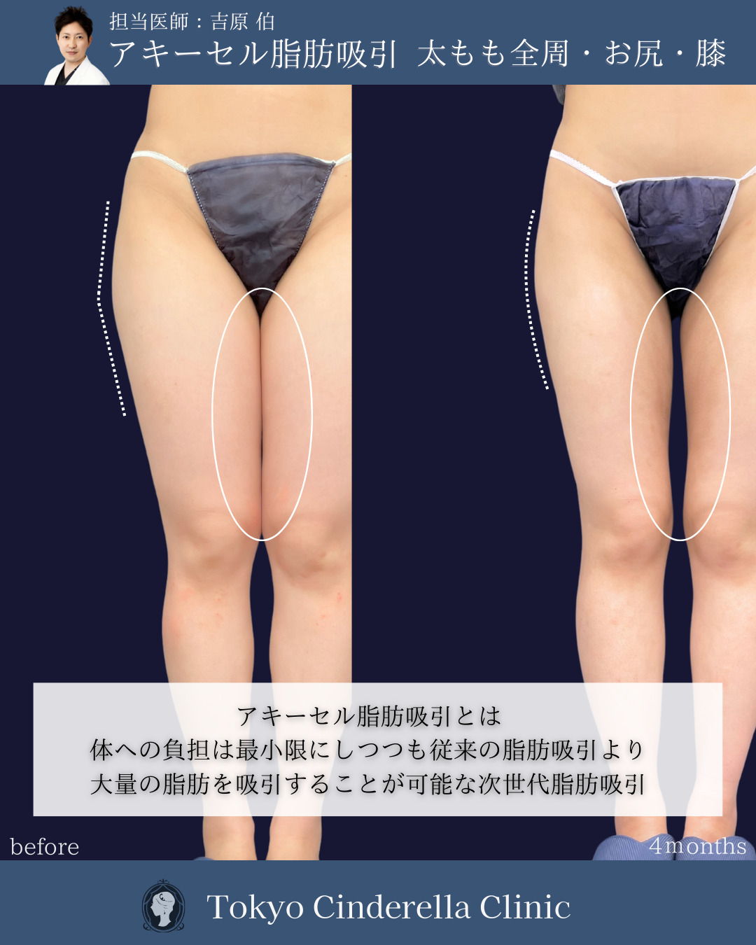 新宿院で行った太もも全周とお尻と膝のアキーセル脂肪吸引の名医の吉原伯医師の症例写真
