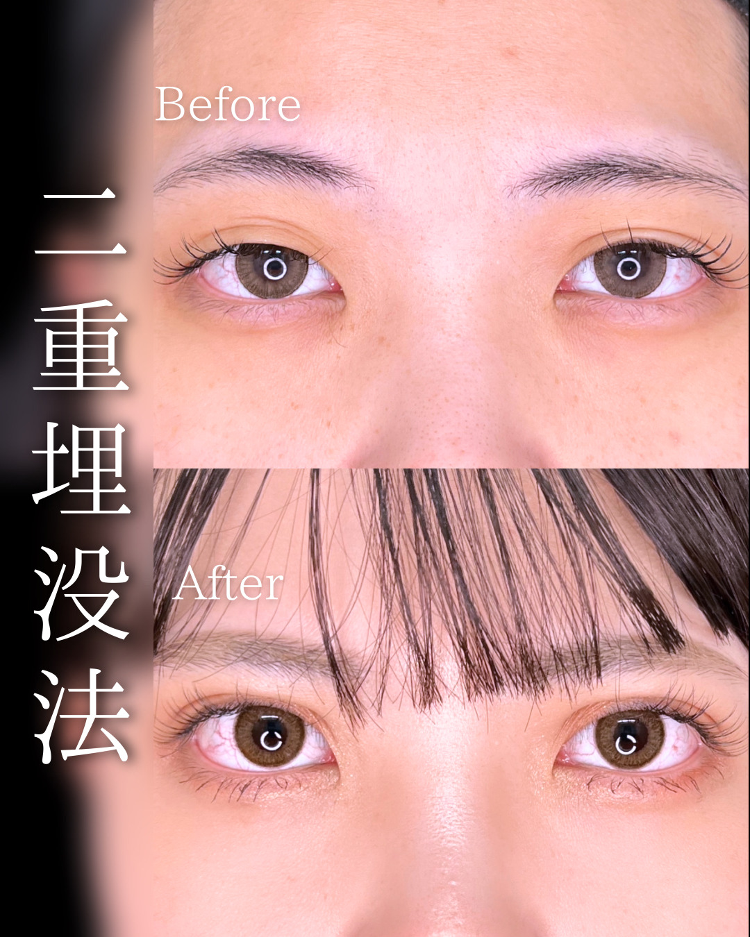 池袋院で行った二重整形の石井達也医師の症例写真