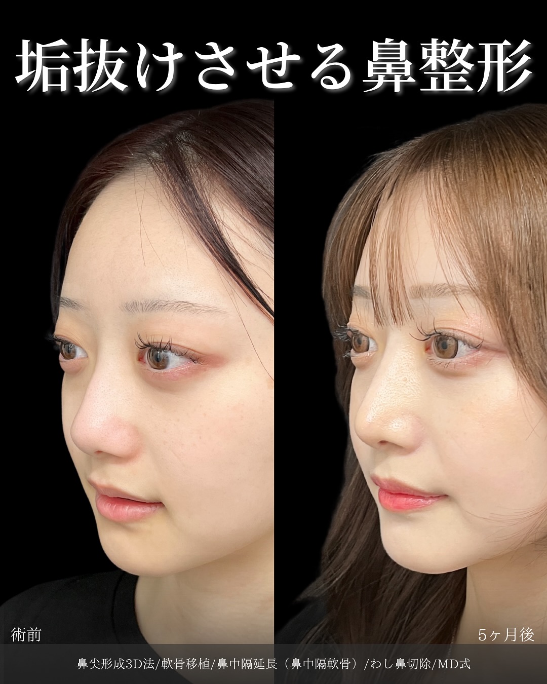 新宿院で行った鼻整形の名医の吉原伯医師のMD式の鼻尖形成3D法と軟骨移植と鼻中隔延長(鼻中隔軟骨)とわし鼻切除の症例写真