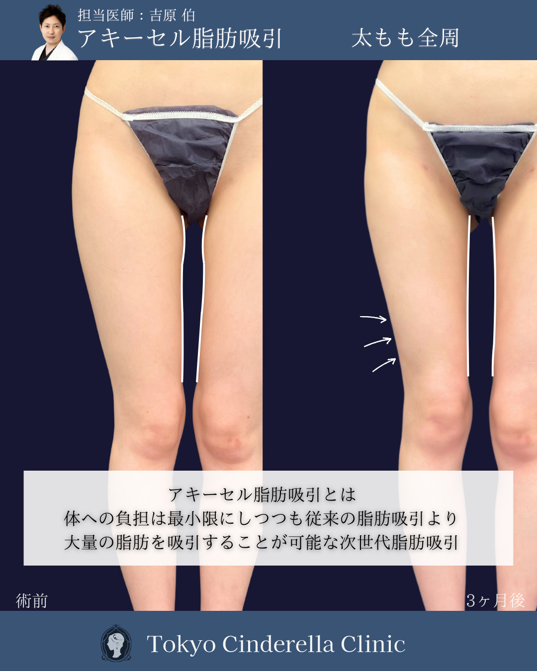 新宿院で行ったアキーセル脂肪吸引(太もも全周) と他院修正の名医の吉原伯医師の症例写真