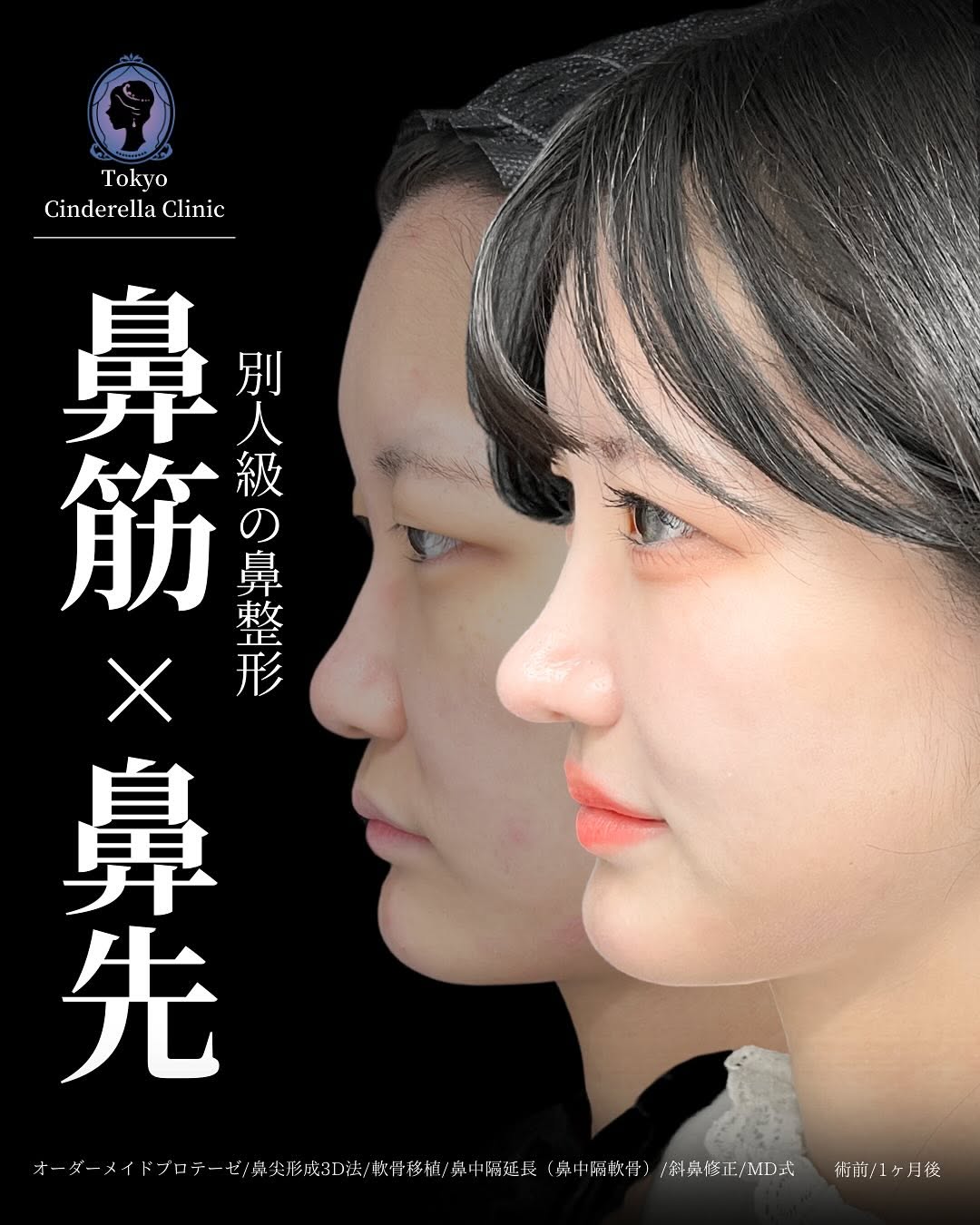 新宿院で行った鼻整形の名医の吉原伯医師のMD式のオーダーメイドプロテーゼと鼻尖形成3D法と軟骨移植と鼻中隔延長(鼻中隔軟骨)と斜鼻修正の症例写真