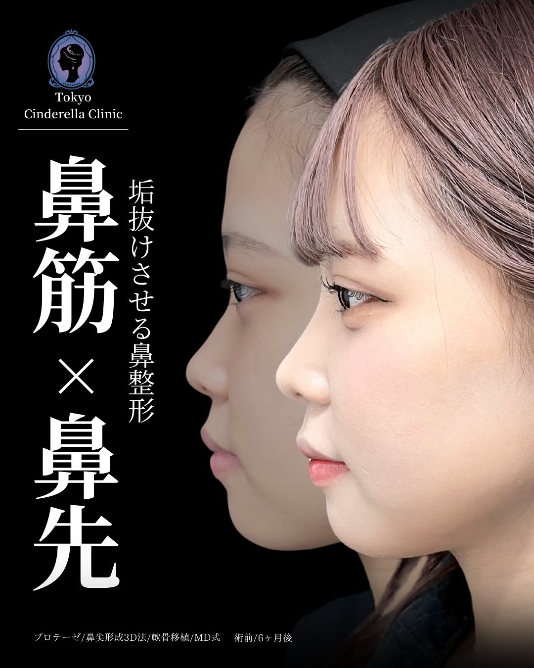 新宿院で行った鼻整形の名医の吉原伯医師のMD式のプロテーゼと鼻尖形成3D法と軟骨移植の症例写真