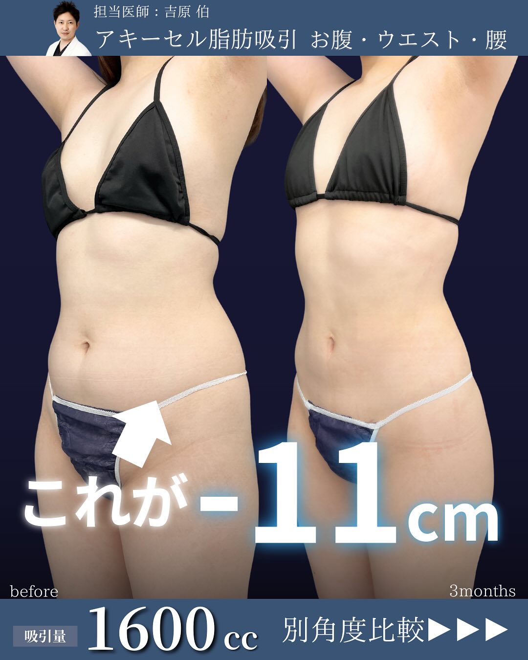 新宿院で行ったアキーセル脂肪吸引(お腹・ウエスト・腰)の名医の吉原伯医師の症例写真