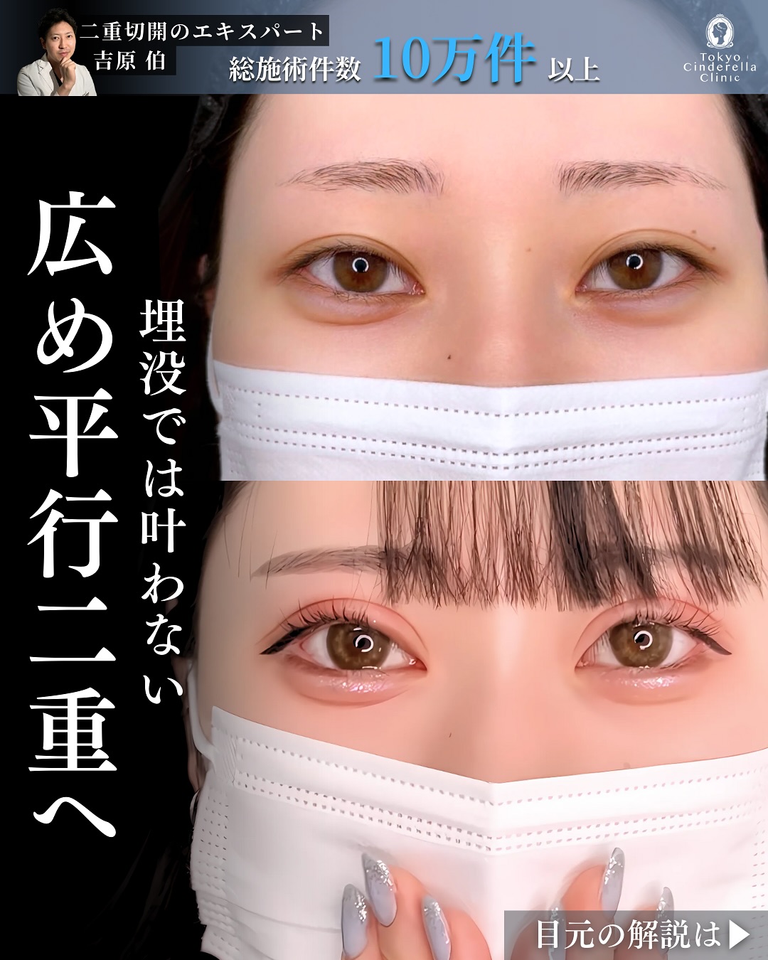 新宿院で行った二重整形で有名な吉原伯医師のMD式のたるみ取り併用全切開法二重術と眼瞼下垂手術と目尻切開とタレ目形成(結膜切開)と埋没法抜糸の6ヶ月後の症例写真