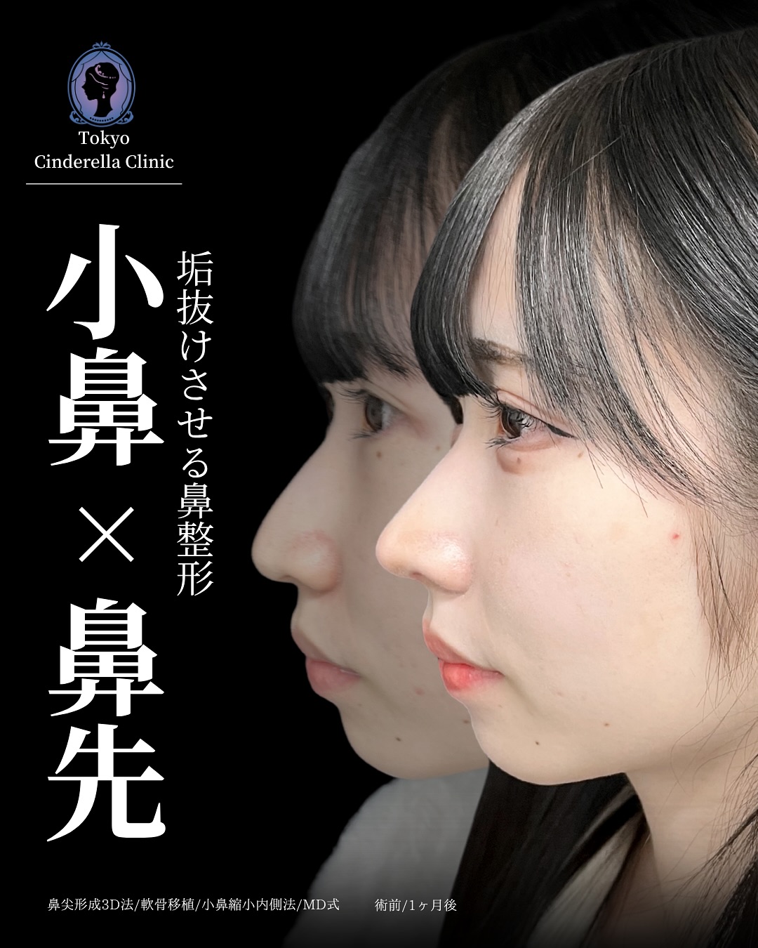 新宿院で行った鼻整形の名医の吉原伯医師のMD式の鼻尖形成3D法と軟骨移植と小鼻縮小内側法の症例写真