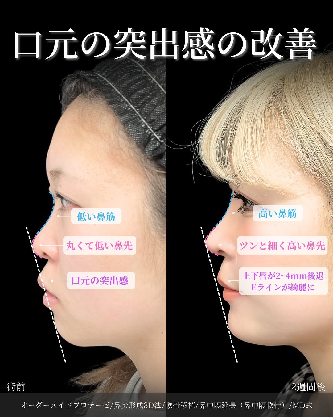 新宿院で行った鼻整形の名医の吉原伯医師のMD式のオーダーメイドプロテーゼと鼻尖形成3D法と軟骨移植と鼻中隔延長(鼻中隔軟骨)の症例写真