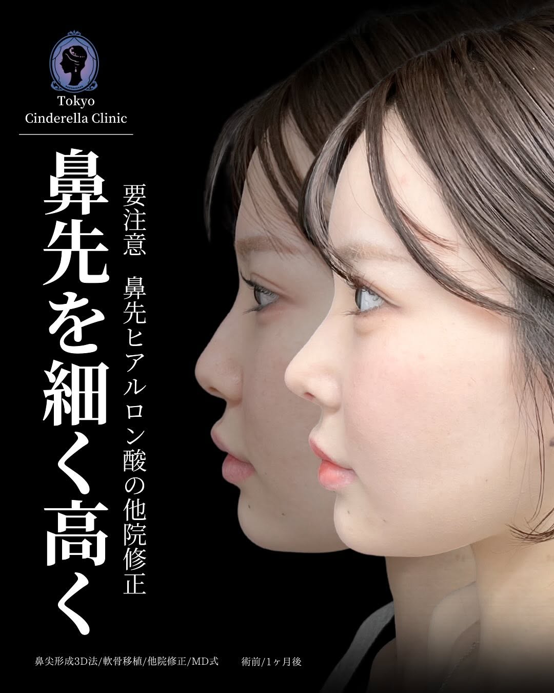 新宿院で行った鼻整形の名医の吉原伯医師のMD式の鼻尖形成3D法と軟骨移植と他院修正の症例写真