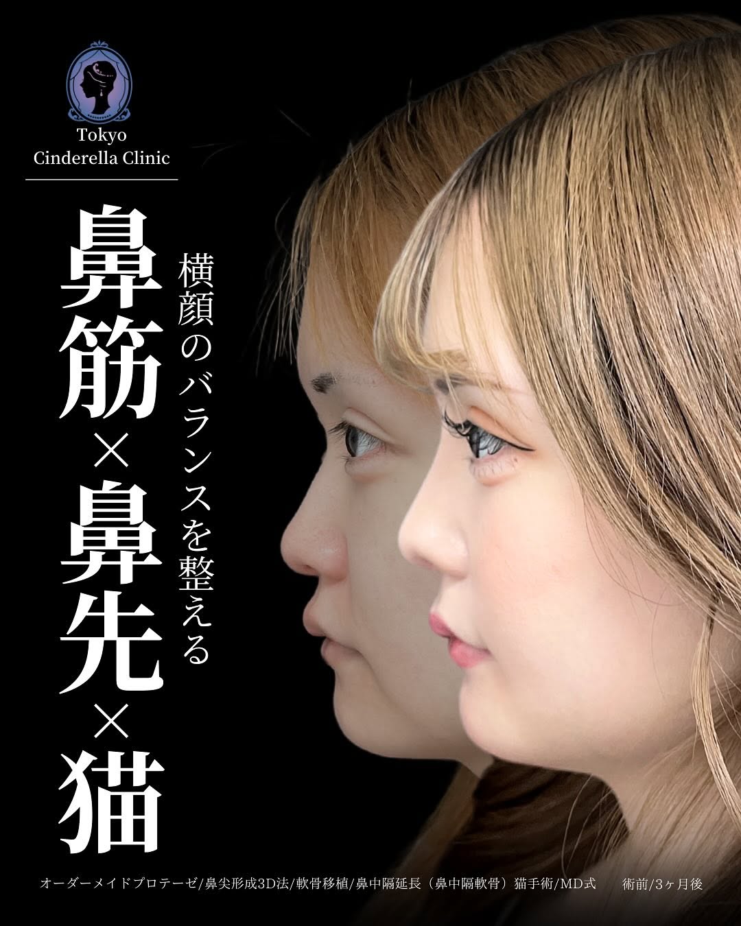 新宿院で行った鼻整形の名医の吉原伯医師のMD式のオーダーメイドプロテーゼと鼻尖形成3D法と軟骨移植と鼻中隔延長(鼻中隔軟骨)と猫手術の症例写真