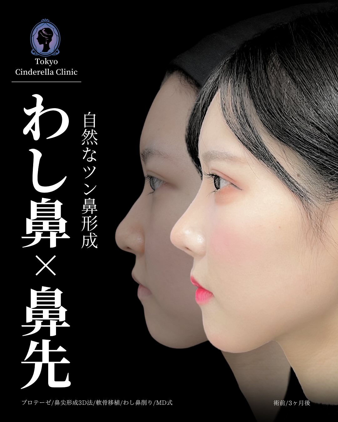 新宿院で行った鼻整形の名医の吉原伯医師のMD式のプロテーゼと鼻尖形成3D法と軟骨移植とわし鼻削りの症例写真