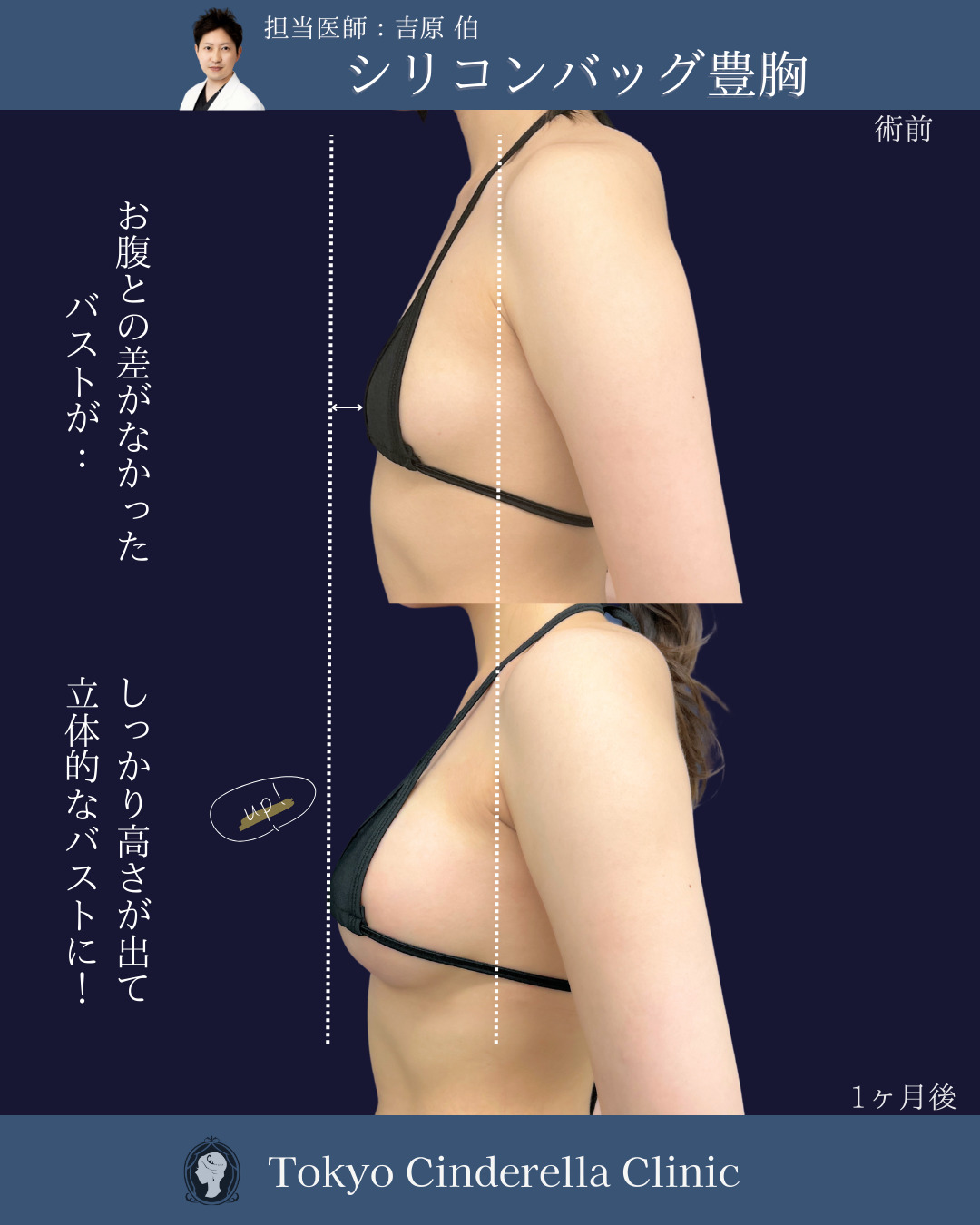 新宿院で行ったシリコンバッグ豊胸の名医の吉原伯医師の症例写真