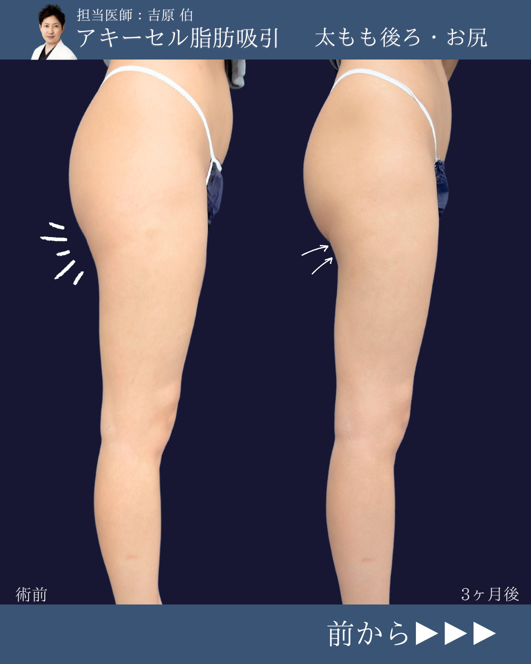 新宿院で行った脂肪吸引で有名な吉原伯医師のアキーセル脂肪吸引(太もも後ろ・お尻)と他院修正の3ヶ月後の症例写真